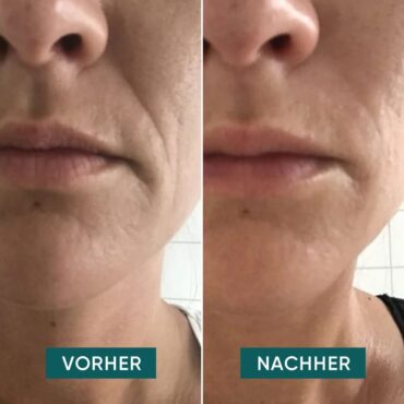 APRICOT_Website_Produktbilder_Mouth-Pads11_1024x1024.jpg.jpeg