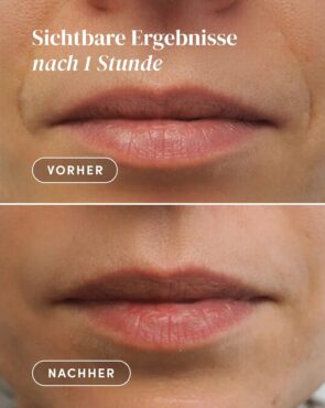 hyaluron-mund-falten-patches-vorher-nachher-ergebnisse-apricot_1435x1800.jpg